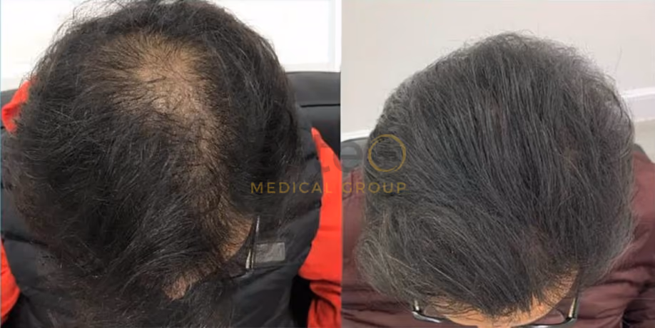 Laser Hair Regrowth Before & After