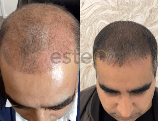 Laser Hair Regrowth Before & After