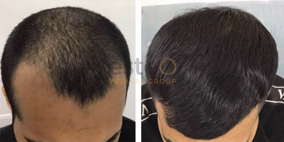 Laser Hair Regrowth Before & After