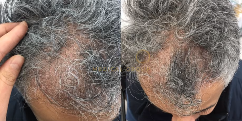 Laser Hair Regrowth Before & After