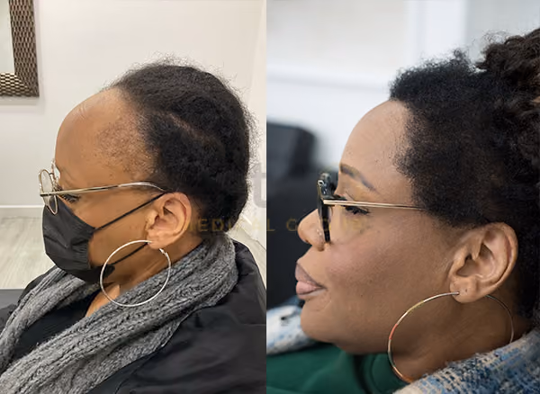 Micheale - Female Hair Transplant Before After Image