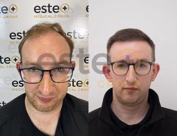 FUE Hair Transplant Results