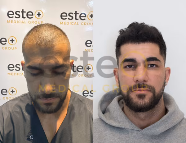 FUE Hair Transplant Results