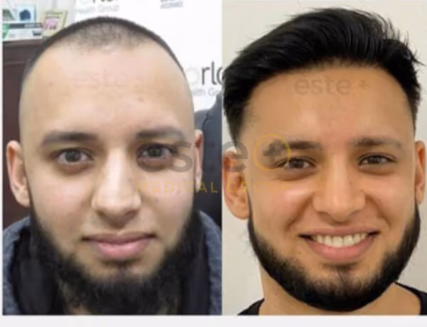 Hair transplant before and after Leeds
