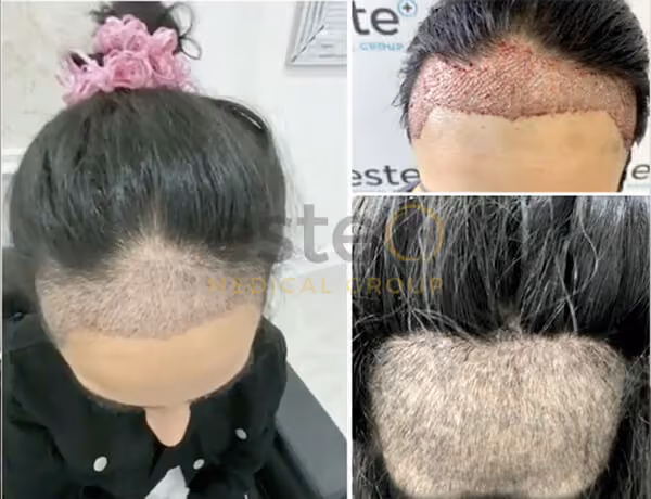 Hair transplant before and after Leeds
