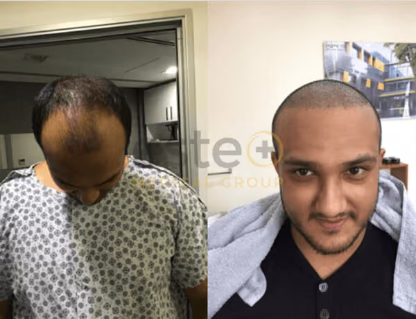 Hair transplant before and after Leeds