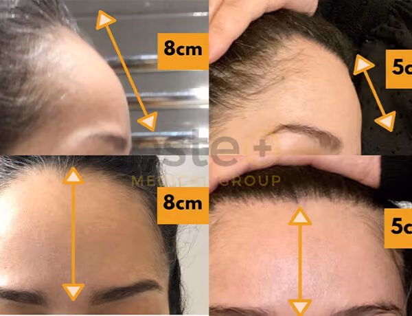 Hair transplant before and after Leeds