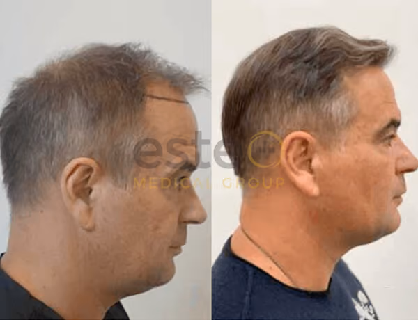 Hair transplant before and after Leeds
