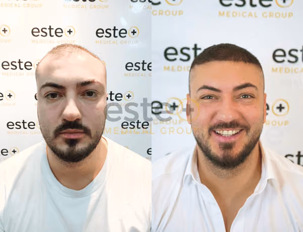 Hair transplant before and after Leeds