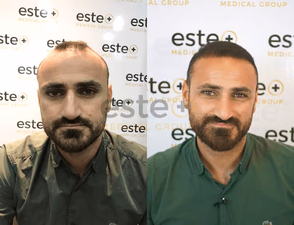 Hair transplant before and after Leeds
