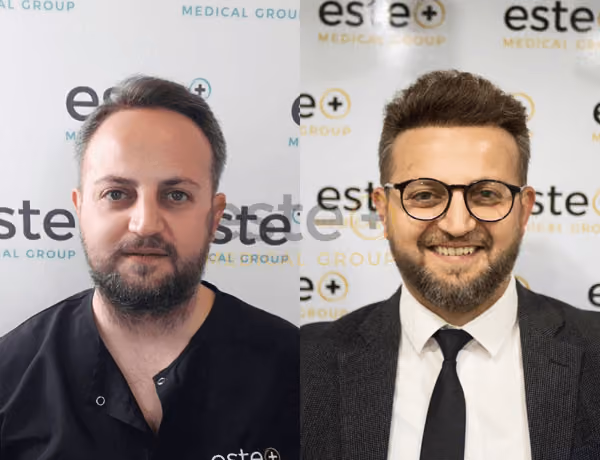 Hair transplant before and after Leeds