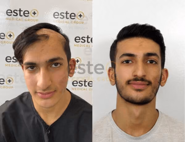 Hair transplant before and after Leeds