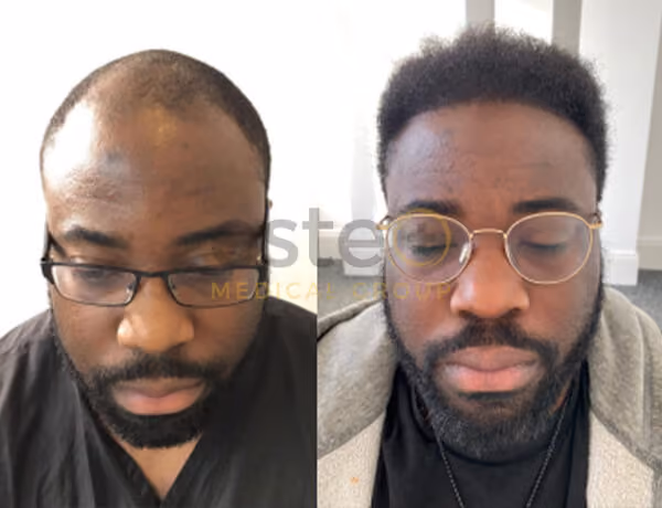 Hair transplant before and after Leeds