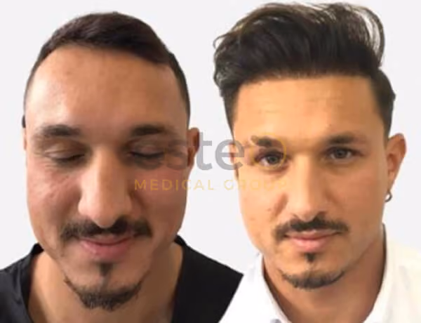 Hair transplant before and after Leeds