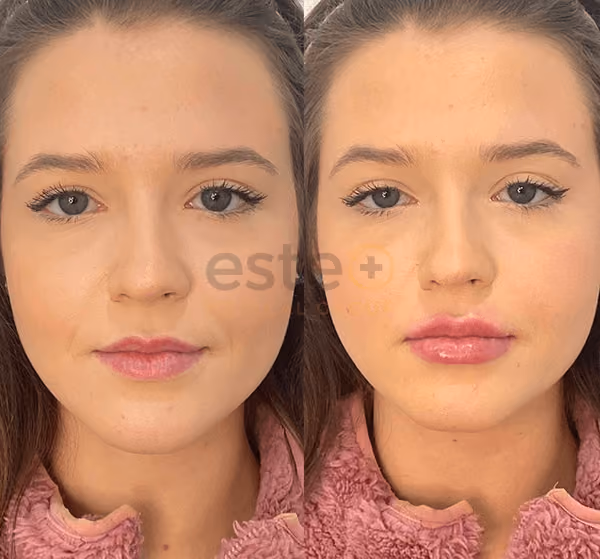 lip filler before after image
