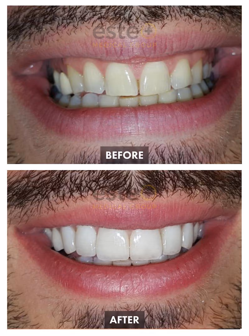 Veneers Before and After