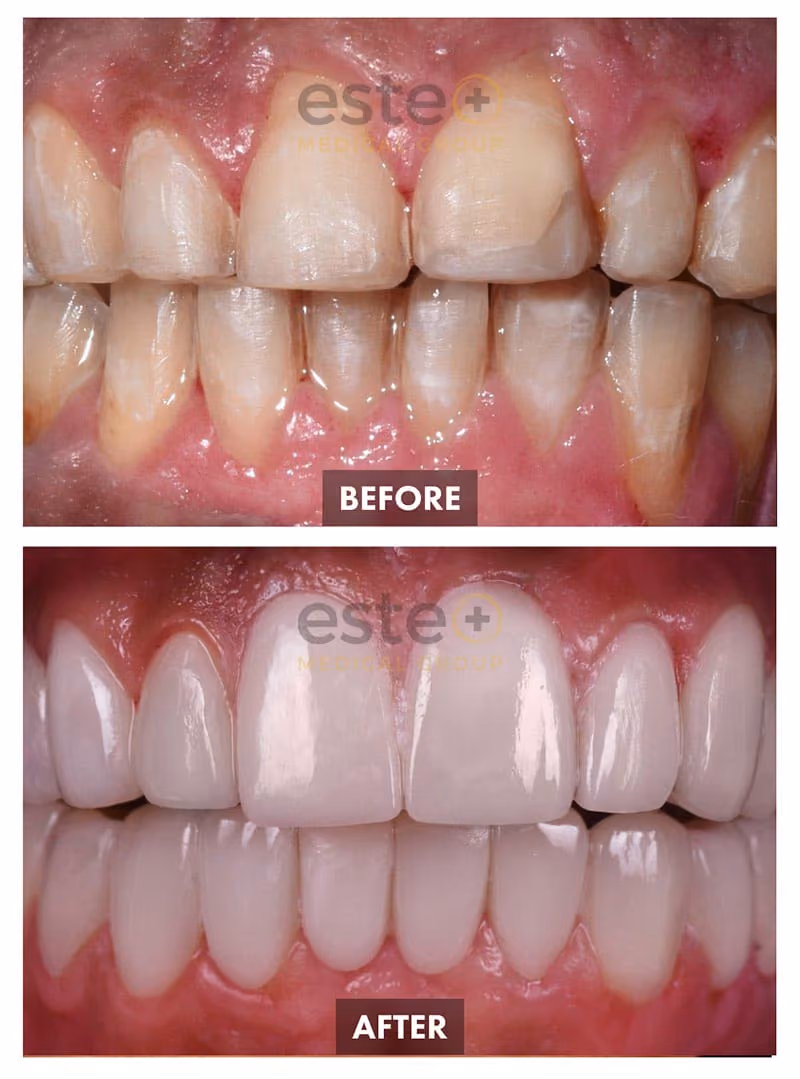 Veneers Before and After