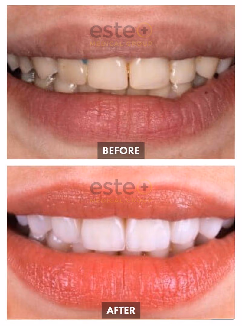 Veneers Before and After
