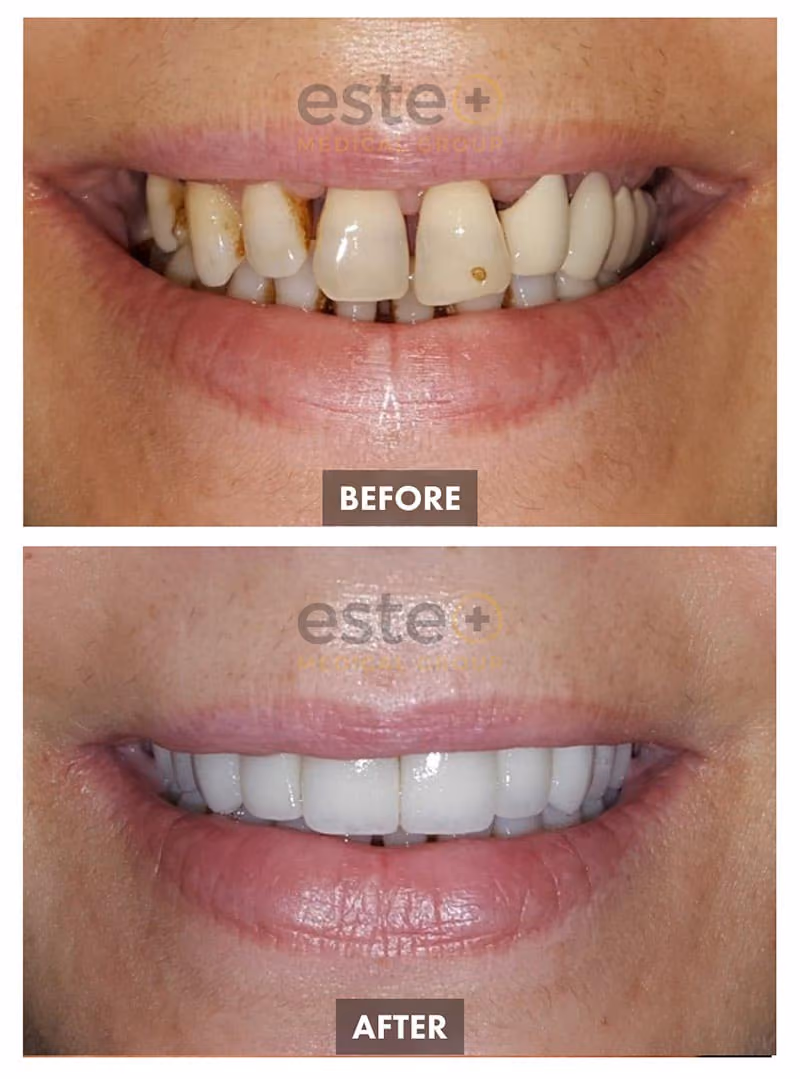 Veneers Before and After