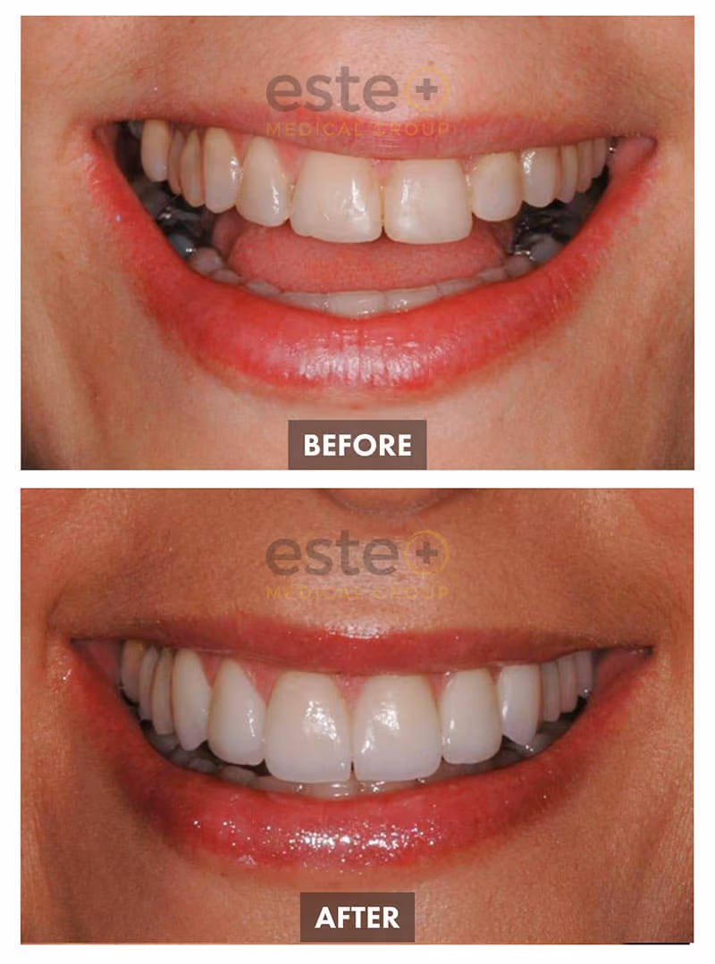 Veneers Before and After