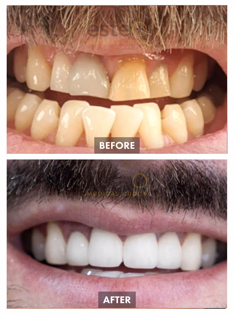 Veneers Before and After