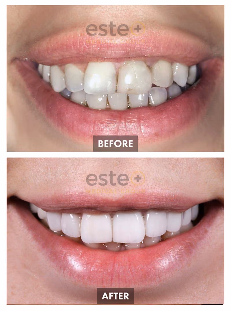 Veneers Before and After