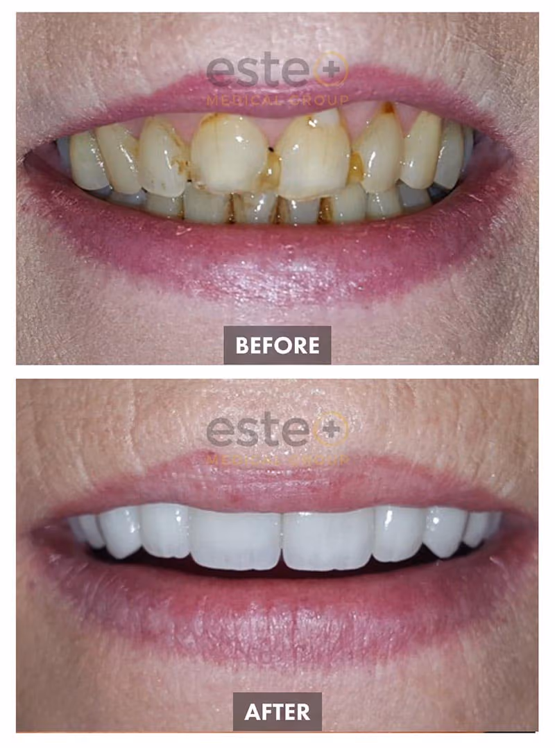 Veneers Before and After