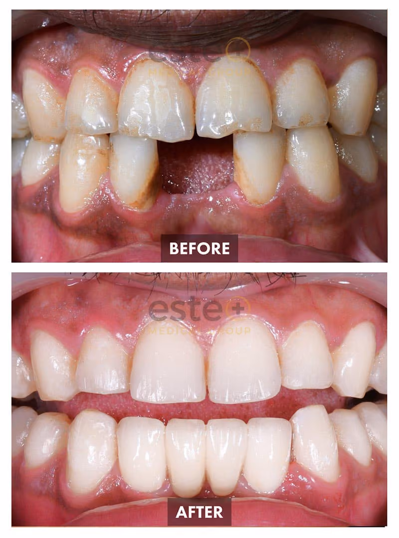 Implants Before and After