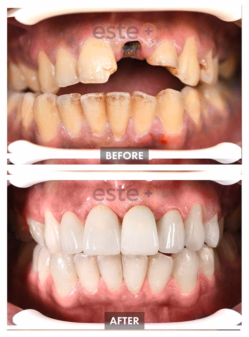 Implants Before and After