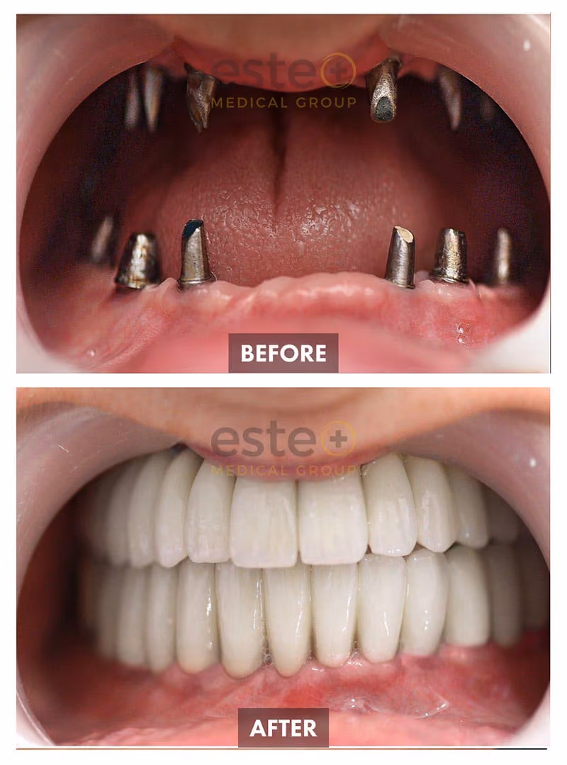 Implants Before and After