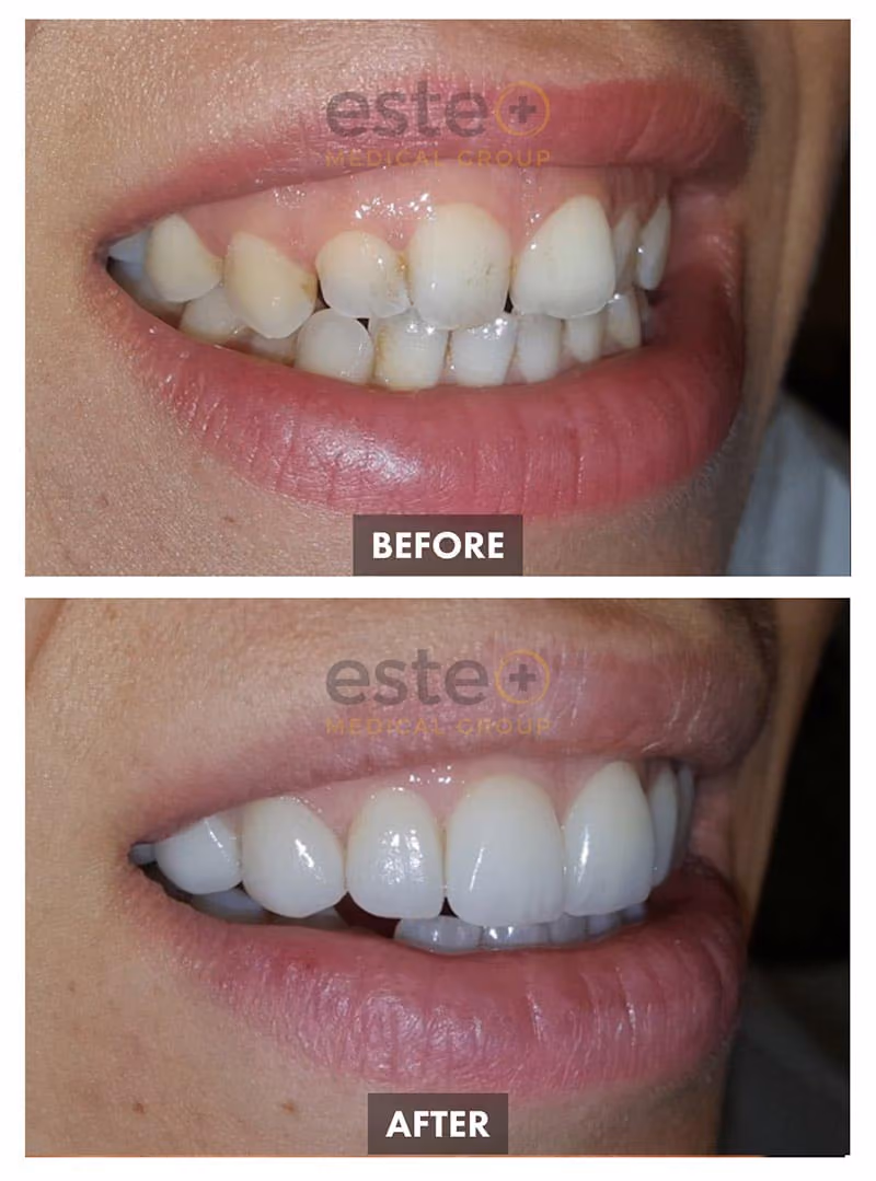 Veneers Before and After