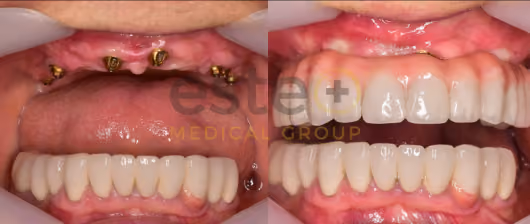 What makes FUE Hair Transplant Procedure the most Successful Technique?
