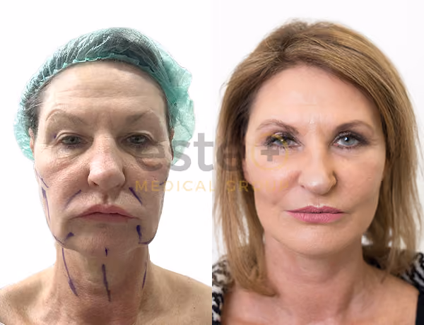 What makes FUE Hair Transplant Procedure the most Successful Technique?