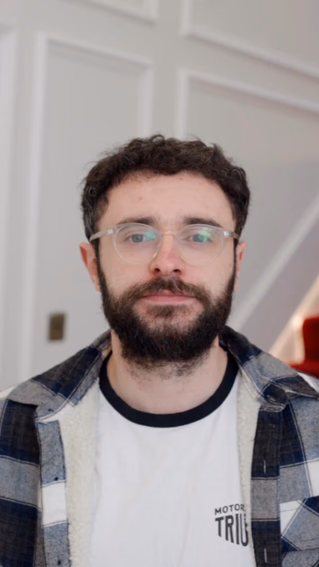 Connor Hair transplant before after post 8 months
