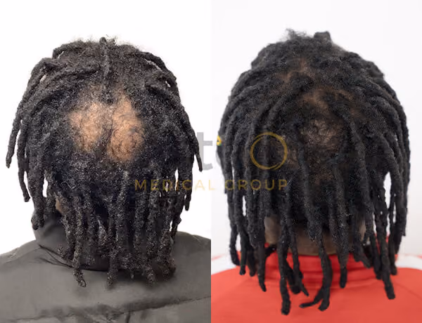 Hair transplant before and after Leeds