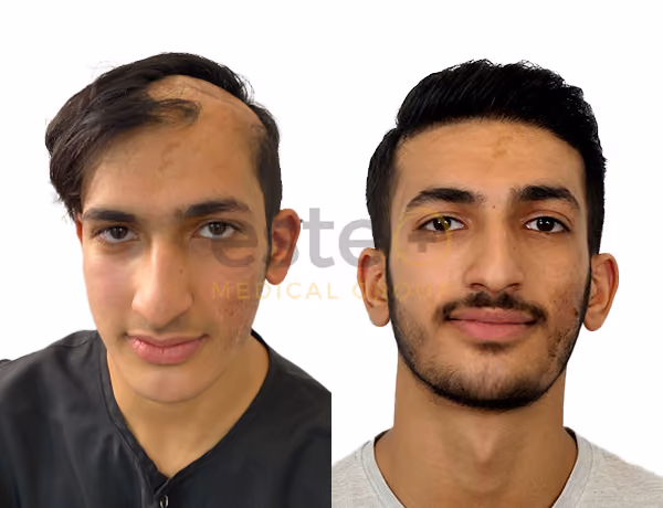 Hair transplant before and after Leeds