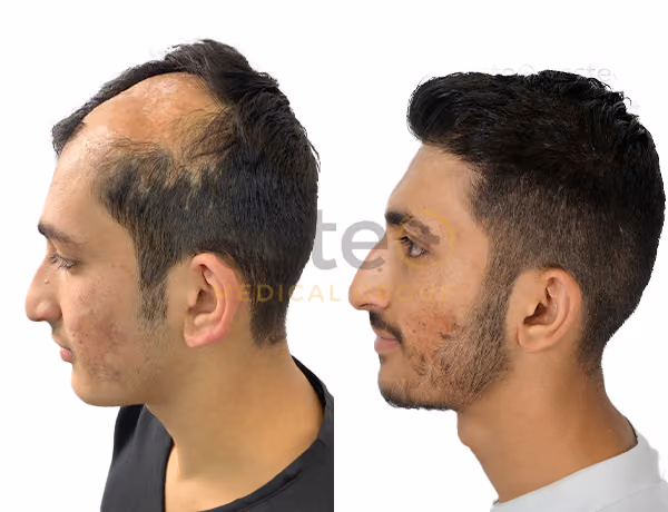 Hair transplant before and after Leeds