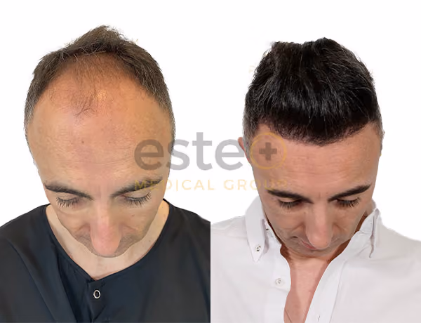 Hair transplant before and after Leeds
