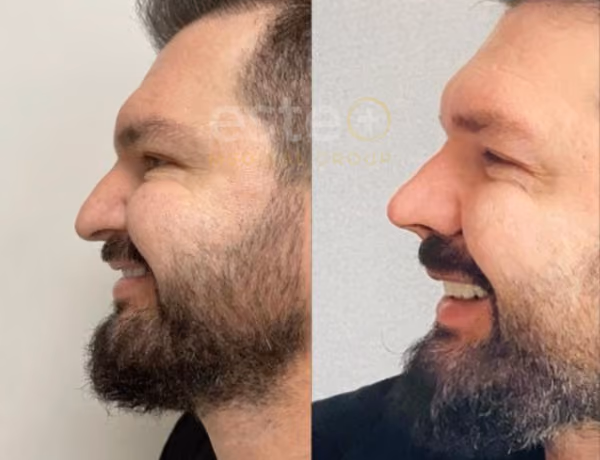 Sam Rhinoplasty surgery before after