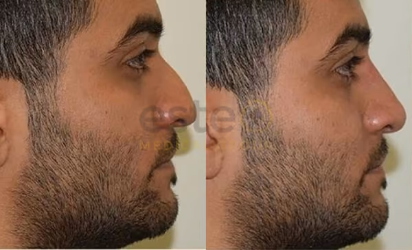Non-Surgical Rhinoplasty before after results
