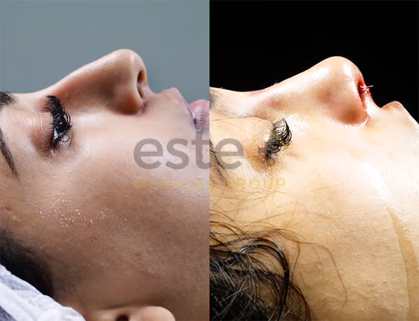 Nose Job Before and After Results