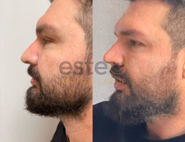 Nose Job Before and After Results