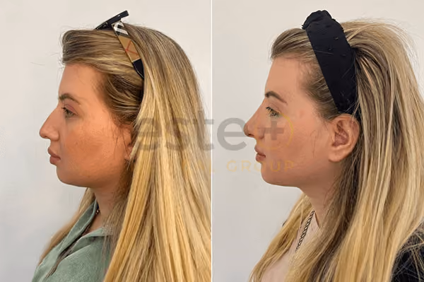 Nose Job Before and After Results