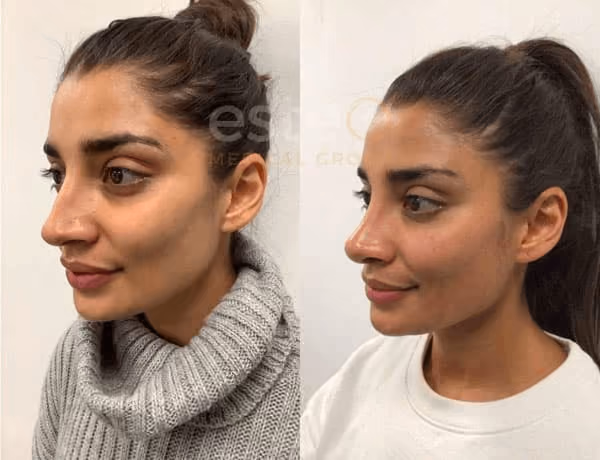 Nose Job Before and After Results