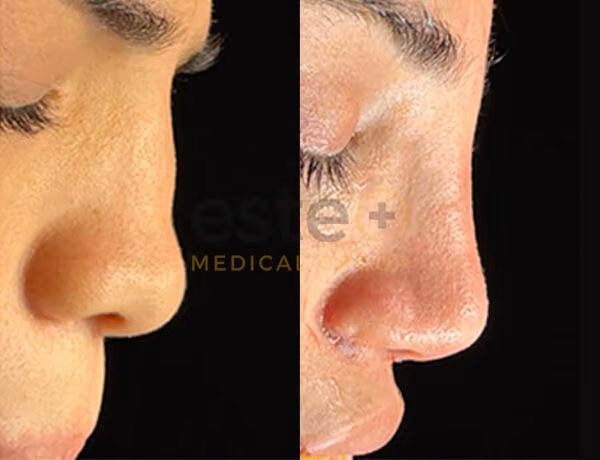 Nose Surgery
