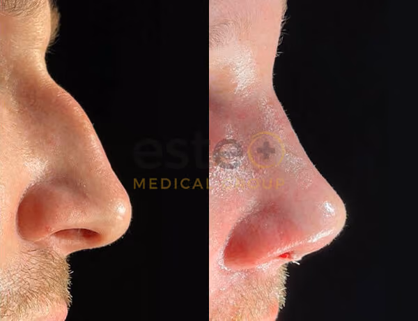 Nose Surgery