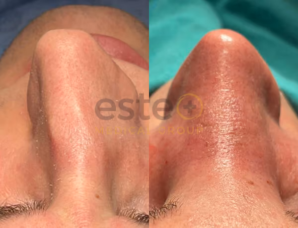Nose Surgery