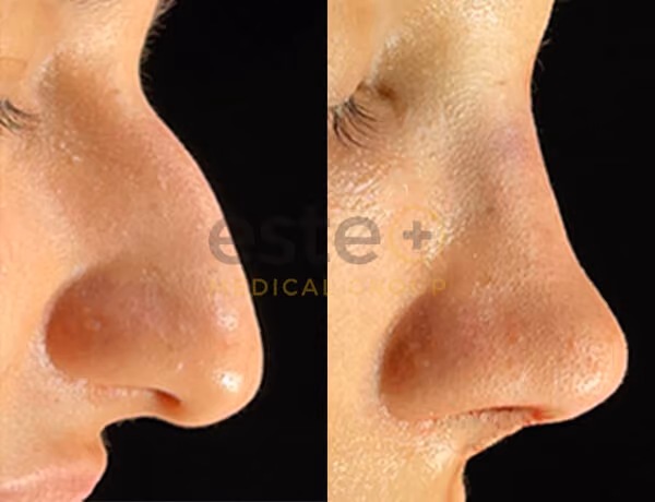 Nose Surgery
