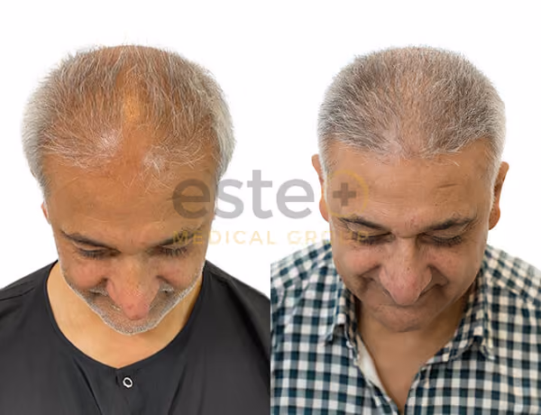 Hair transplant before and after Leeds