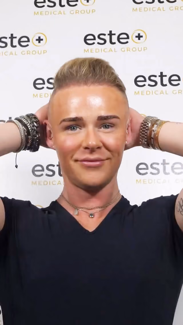 Sean Hair Transplant - Este UK